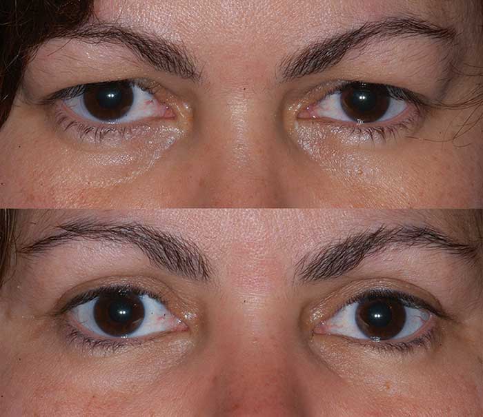 Before and After Upper Eyelid Surgery / Blepharoplasty