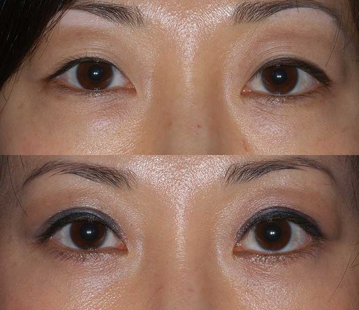Before and After Upper Eyelid Surgery / Blepharoplasty